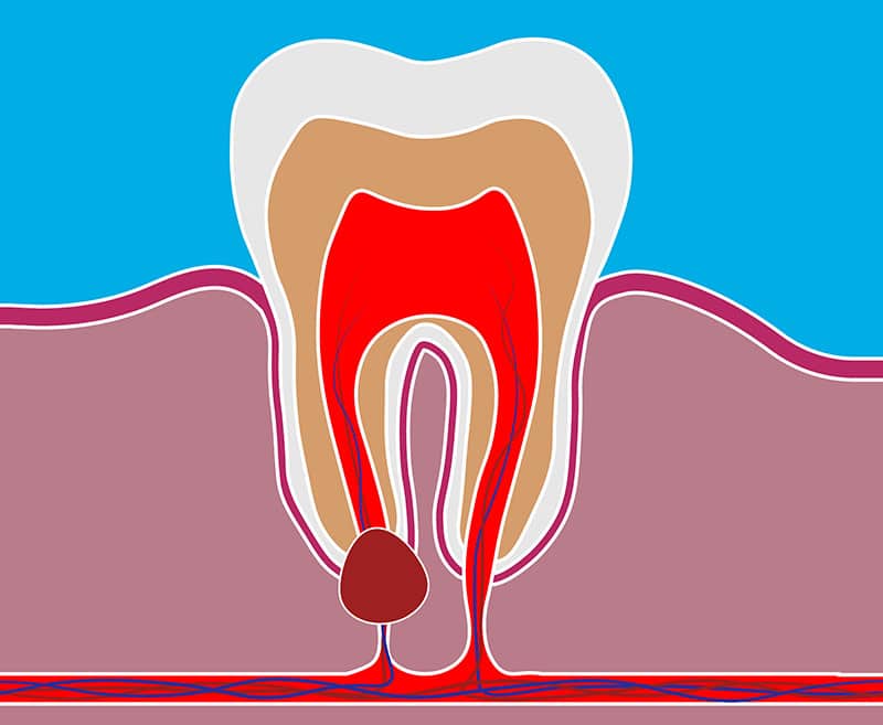 Dental Cyst Management