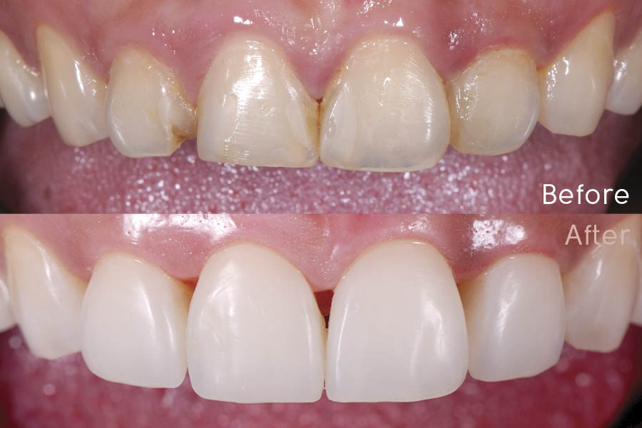 Esthetic Composite Restorations