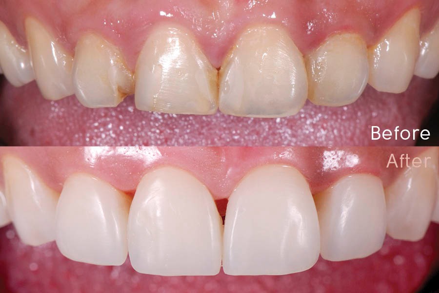 Esthetic Composite Restorations