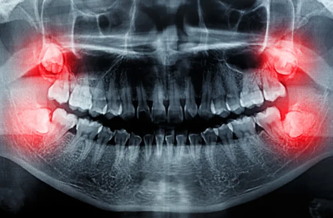 Wisdom Teeth Extraction