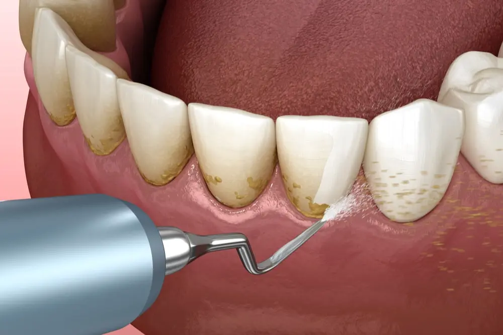 Scaling and polishing