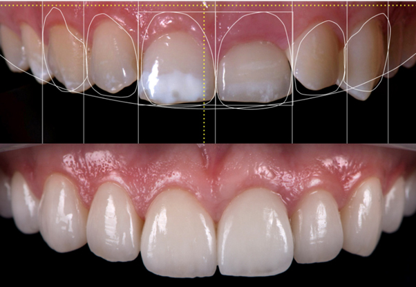 Smile Designing & Veneers