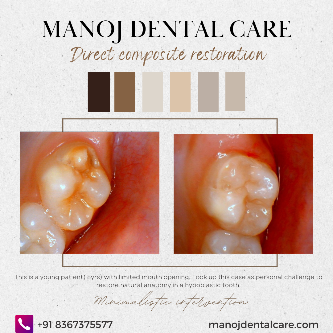 tooth coloured filling