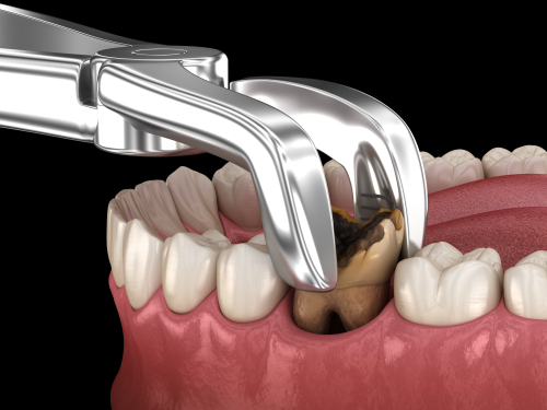 Teeth Extraction