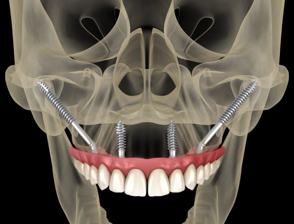 Zygomatic Implants